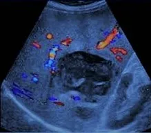 Hepatic abscess color Doppler ultrasound