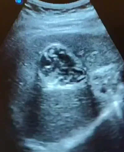 Hepatic abscess ultrasound showing irregular margins