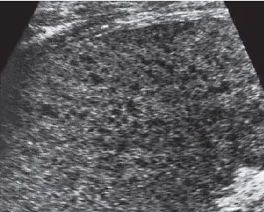 Early stage candidiasis with hypoechoic nodules