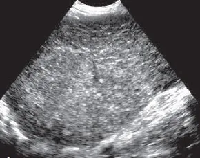 Coarse echotexture due to cirrhosis