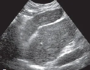 Enormous caudate lobe - Cirrhosis
