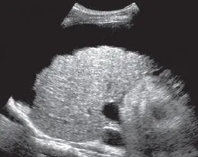 End stage cirrhosis