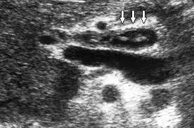 Liver fluke in duct