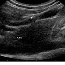 Liver fluke periductal fibrosis
