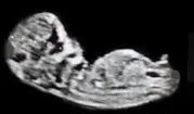 Male Sagittal Sign (Nub Theory)