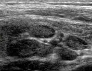 Mesenteric adenitis ultrasound