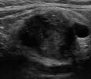 Metastatic lymph node