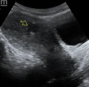 Uterine fibroid