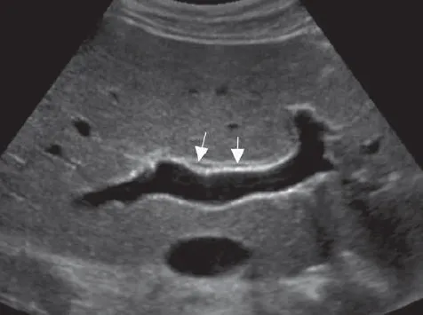 Normal bile ducts