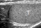 Normal epididymis