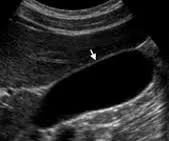 Normal gallbladder