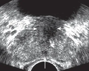 Normal prostate TRUS