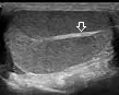 Normal testis ultrasound