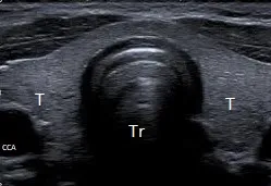 Normal Thyroid