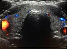 Normal Thyroid Vascularity