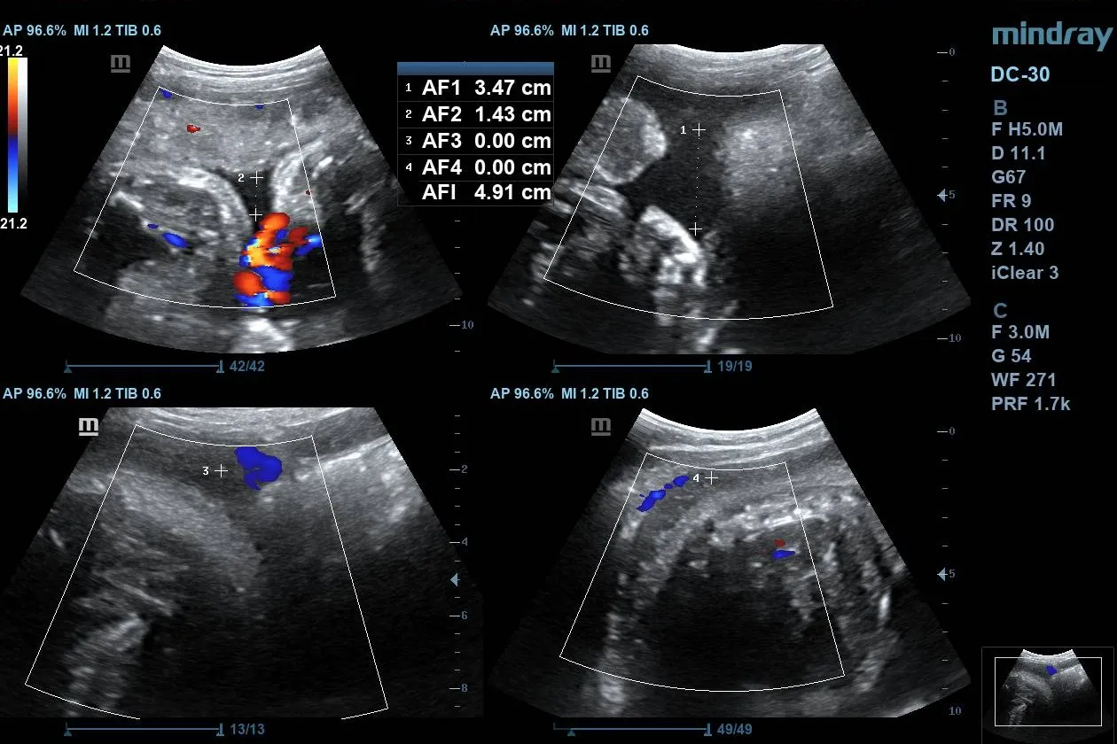 Amniotic fluid assessment