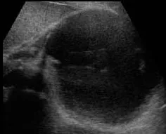 Pancreatic pseudocyst ultrasound showing anechoic collection