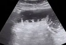 Paralytic Ileus