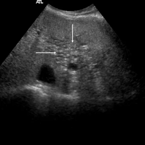 Ultrasound image of peribiliary cysts