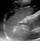 Perisplenic fluid ultrasound