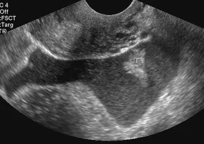 Free pelvic fluid ultrasound