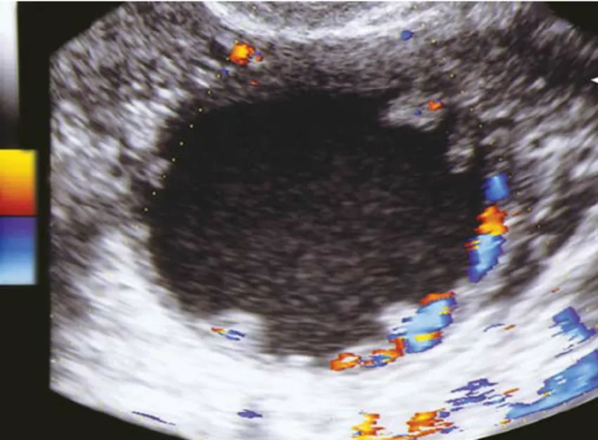 Cogwheel sign ultrasound