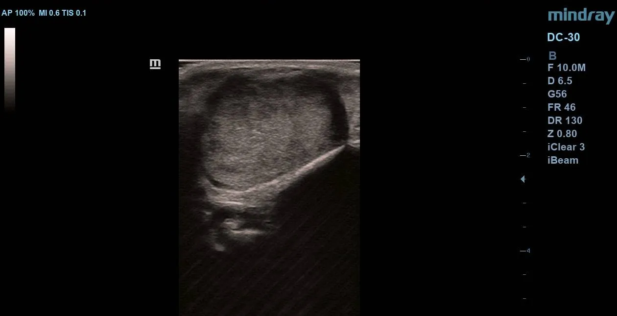 Gray-scale ultrasound scan of the right parotid gland showing a well-circumscribed hypoechoic solid mass with smooth margins.