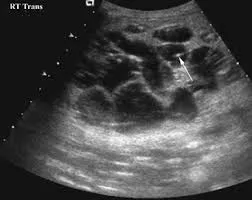 Classic ultrasound appearance of polycystic liver disease