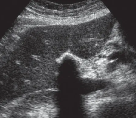 Porcelain Gallbladder