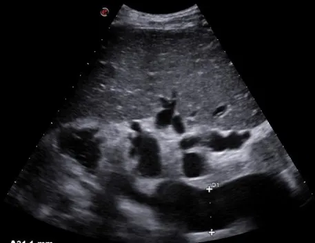 Splenic vein dilation and collaterals at the splenic hilum
