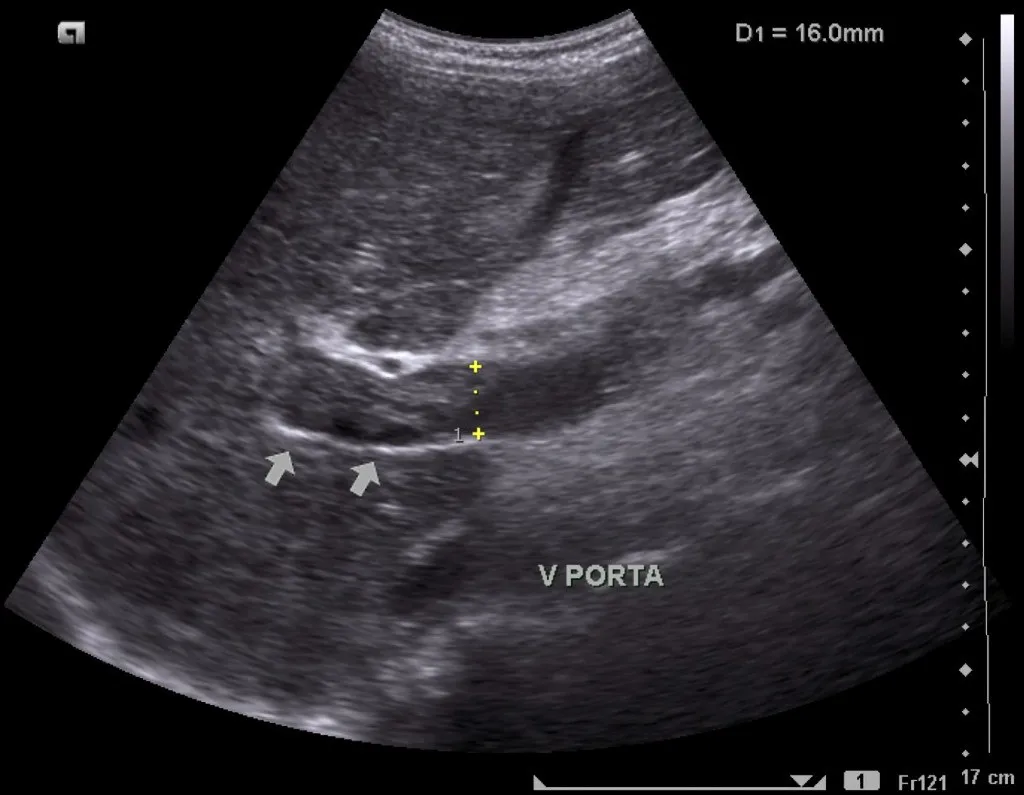 Echogenic contents in the portal vein lumen signaling acute thrombosis