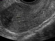 Proliferative phase