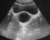 Prostate cyst