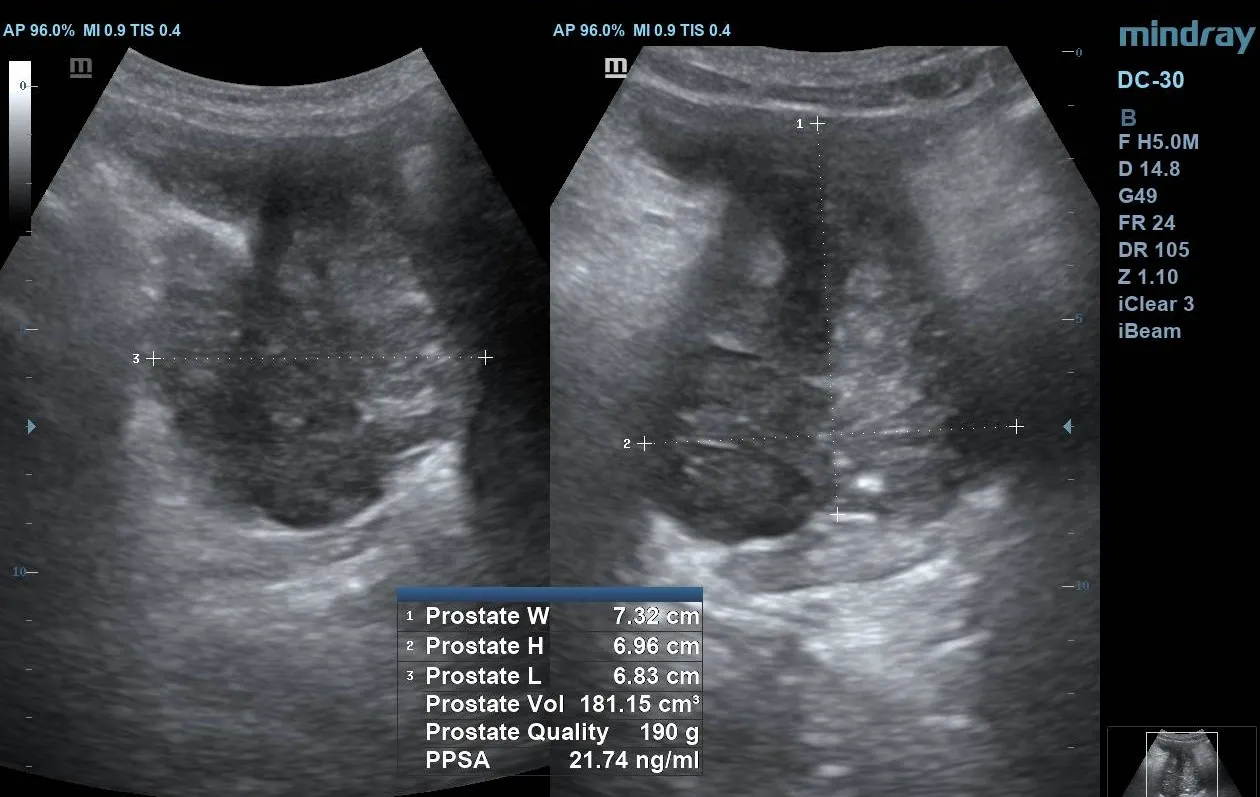 Ultrasound image demonstrating prostate volume measurement significantly above normal range.