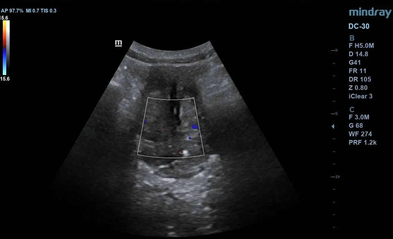 Sagittal ultrasound showing median lobe enlargement projecting into bladder base.