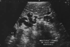 Recurrent Pyogenic Cholangitis stones