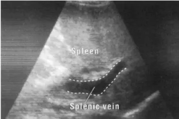Splenic vein dilatation