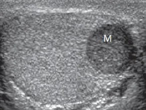 Testicular tumor
