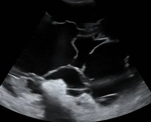 Septated ascites
