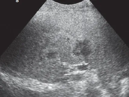 Spleen Gaucher disease