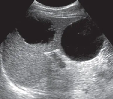 Splenic cyst