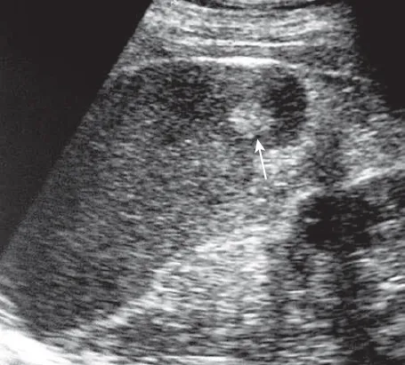 Splenic Hemangioma