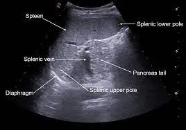 Splenic Vein