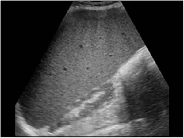 Splenomegaly Ultrasound