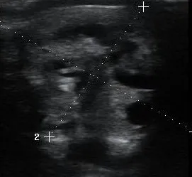 Benign thyroid nodule