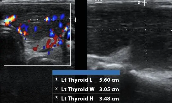 Hashimoto's Thyroiditis left lobe ultrasound