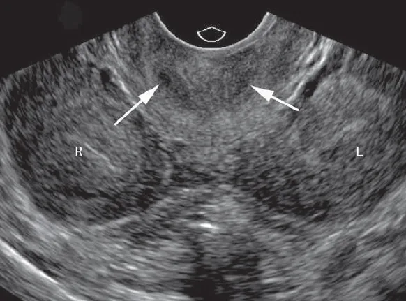 Uterus didelphys