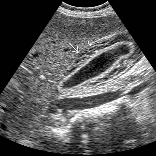 Gallbladder wall thickening in Viral hepatitis